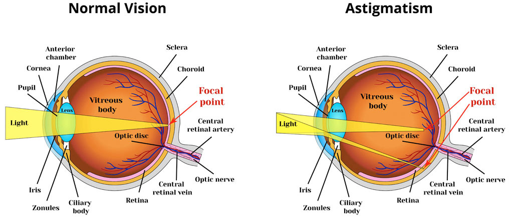 Normal Vision VS. Astigmatism