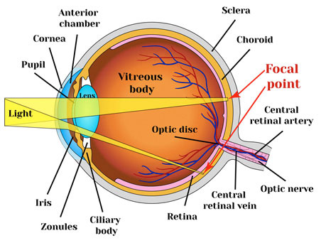 Hyperopic Astigmatism