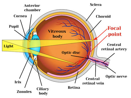 mixed astigmatism