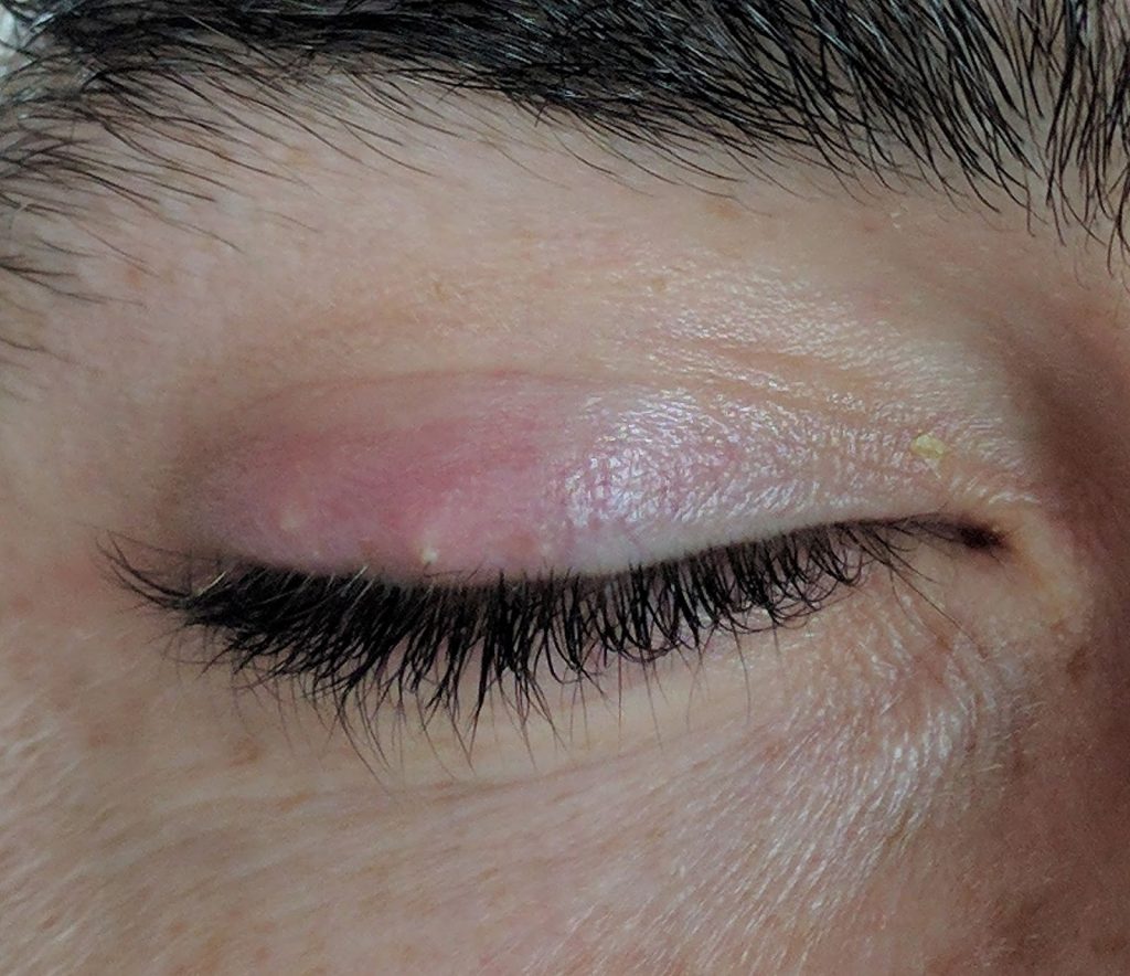 7 Ways To Treat Or Get Rid Of A Stye