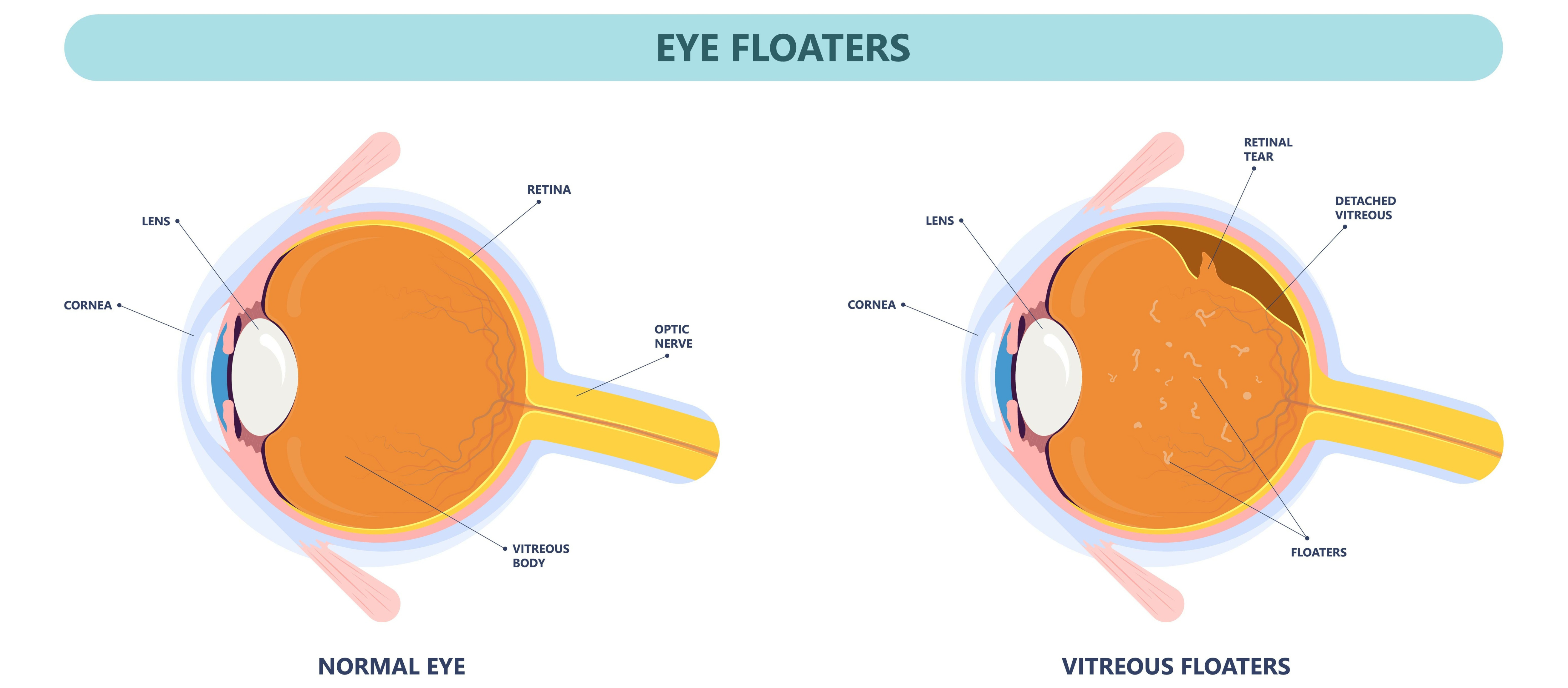 What Causes Floaters in Your Eyes?